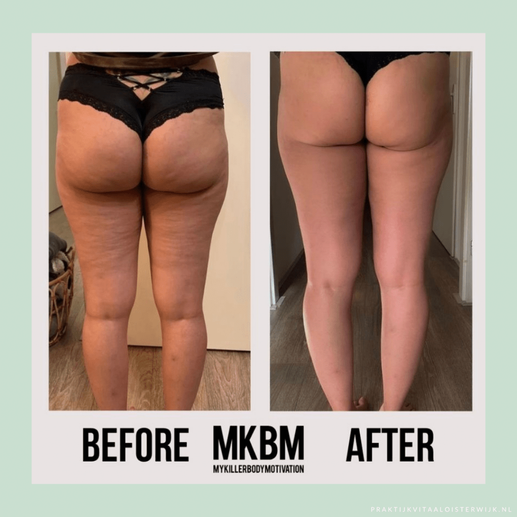 MKBM Cellulite Cups